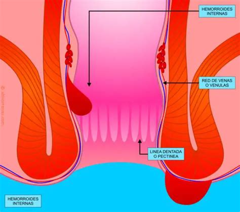 fotos reales de hemorroides|Bilder von Hämorrhoiden: Vier Schweregrade